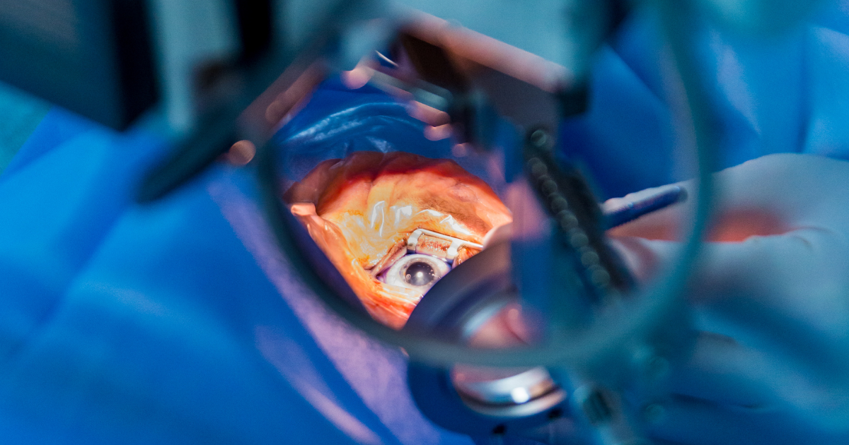 Trabeculectomy v. Trabeculotomy